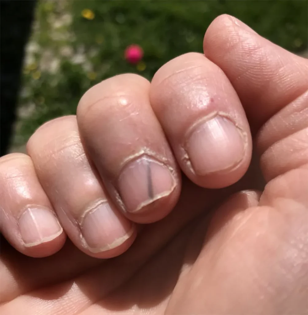 How to Get Splinter out From Under Nail