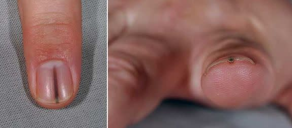 How to Get Splinter out From Under Nail