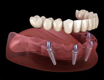How to get dental implants covered by insurance
